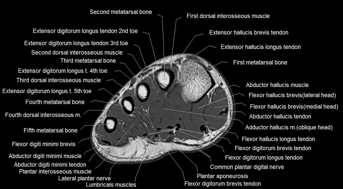MRI 3T foot axial cross sectional anatomy image 16.webp